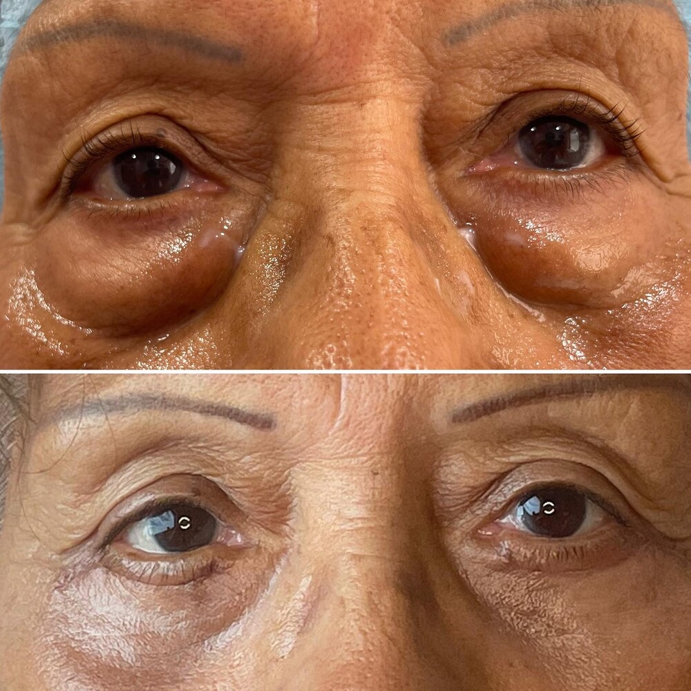 Before and After Result